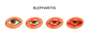 What Aggravates Blepharitis?
